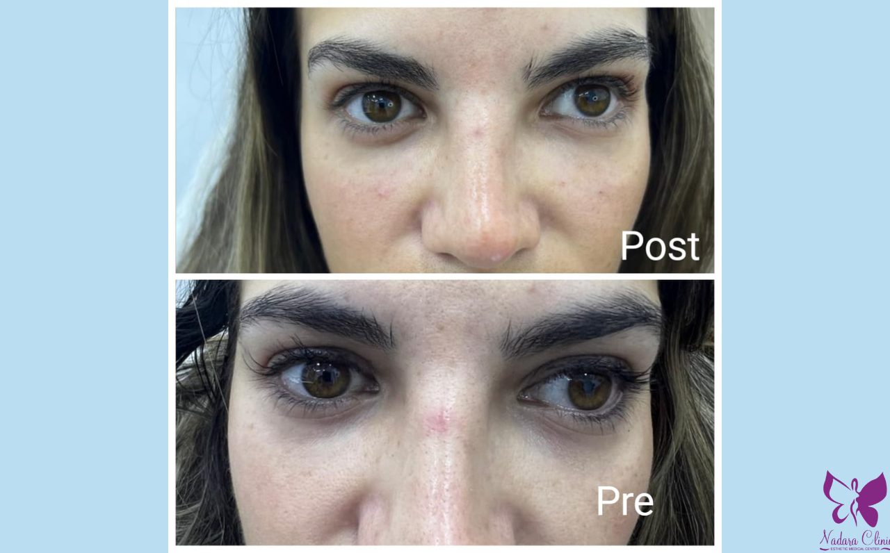 Under eye filler in Hurghada